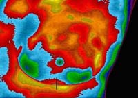 Pre-Lumpectomy Abnormal